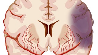 Schematische Darstellung einer transitorisch-ischämischen Attacke (violetter Bereich) 